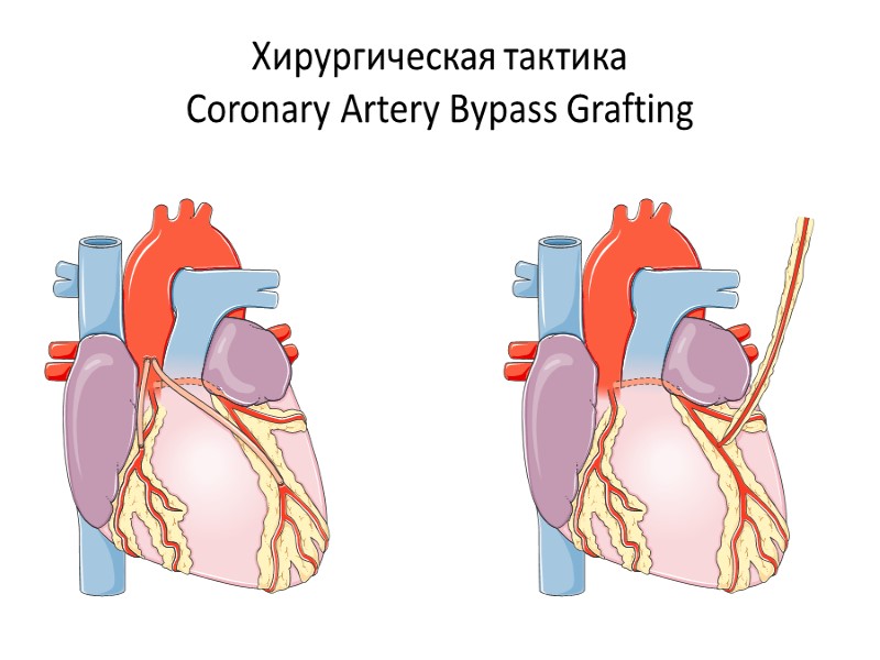 Хирургическая тактика Coronary Artery Bypass Grafting